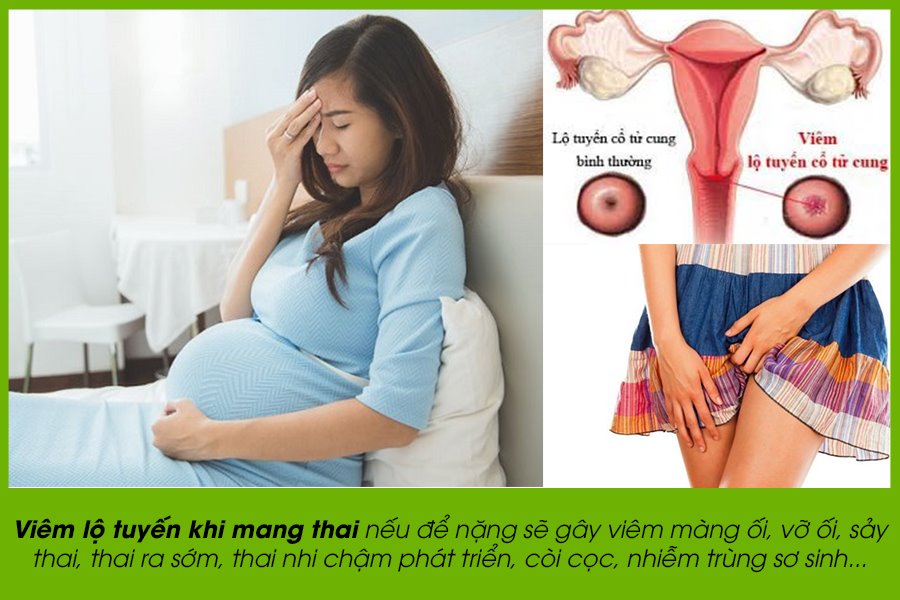 Viêm lộ tuyến cổ tử cung nguy hiểm cho thai nhi