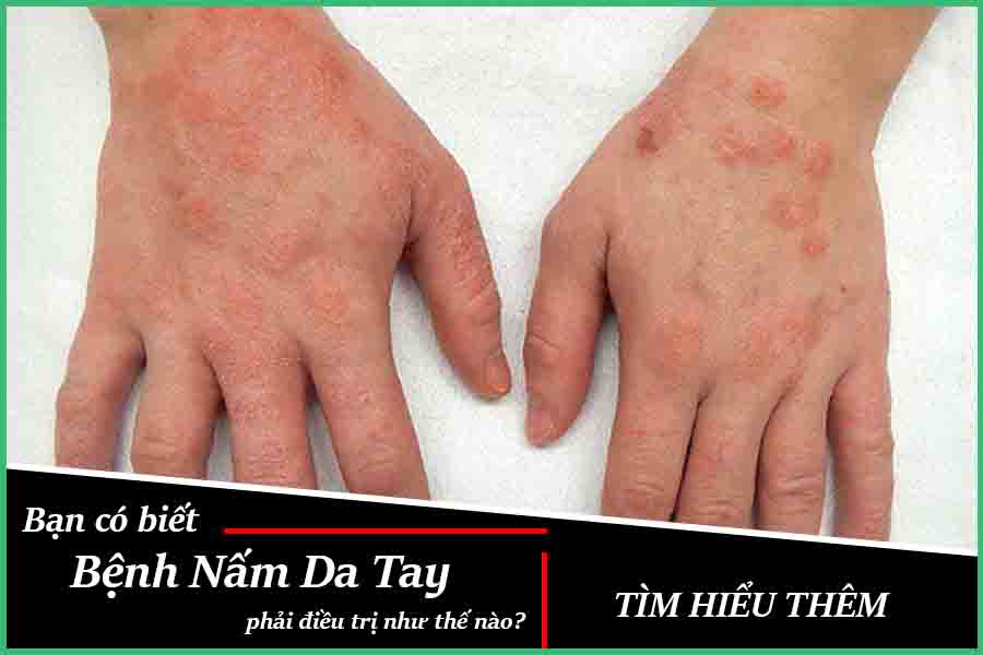 Bệnh nấm da tay