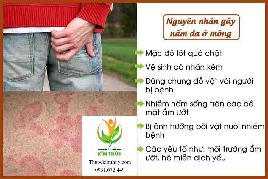 Nguyên nhân gây bệnh nấm da ở mông