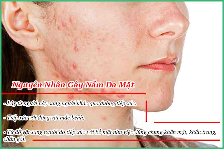 Nguyên nhân gây nấm da mặt