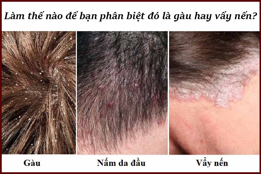 Vẩy nến da đầu |  Nguyên nhân và triệu chứng là gì?